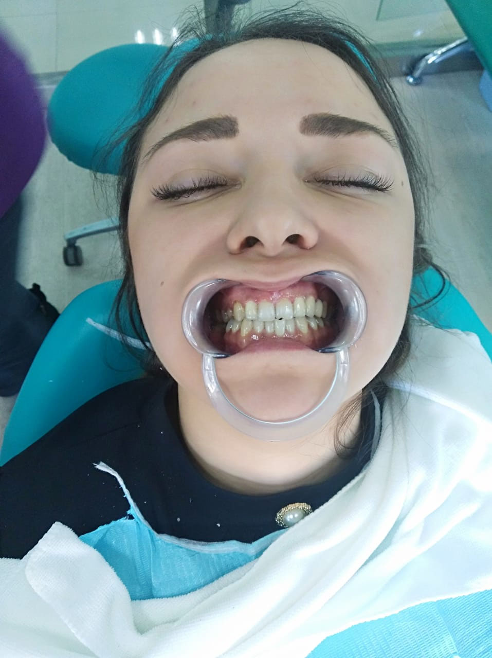 девушка вставила зубы протезирование в Китае